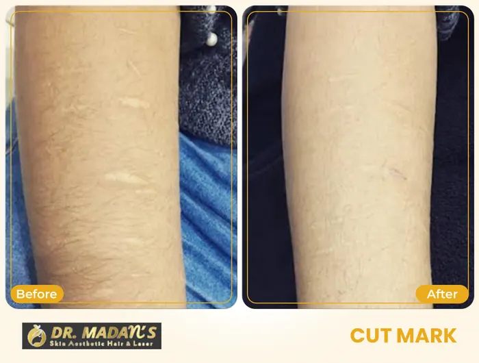 Cut mark before and after result 1 at Dr Madan Aesthetics